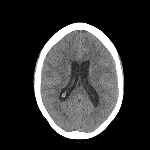 Acute subarachnoid hemorrhage and accessory anterior cerebral artery (Radiopaedia 69231-79008 Axial non-contrast 31).jpg