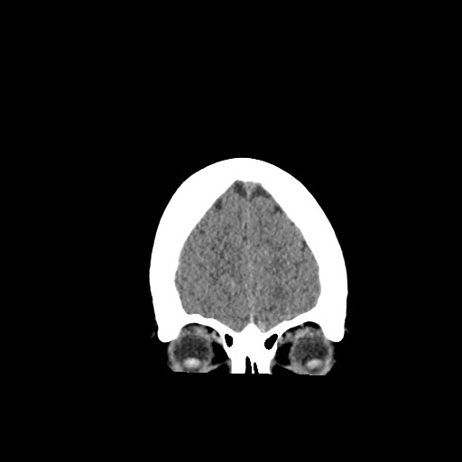 Acute subarachnoid hemorrhage and accessory anterior cerebral artery (Radiopaedia 69231-79008 Coronal non-contrast 13).jpg