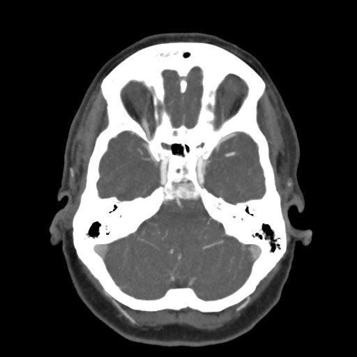 Acute subarachnoid hemorrhage and accessory anterior cerebral artery (Radiopaedia 69231-79009 D 19).jpg