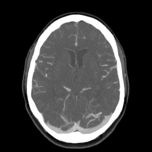 Acute subarachnoid hemorrhage and accessory anterior cerebral artery (Radiopaedia 69231-79009 D 34).jpg