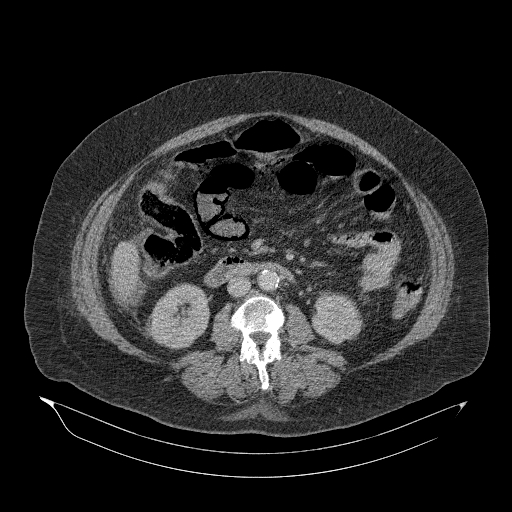 File:Acute superior mesenteric artery occlusion (Radiopaedia 51288-56960 Axial C+ portal venous phase 51).jpg