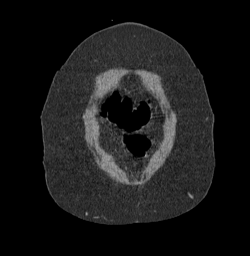 Acute superior mesenteric artery occlusion (Radiopaedia 51288-56960 Coronal C+ portal venous phase 5).jpg