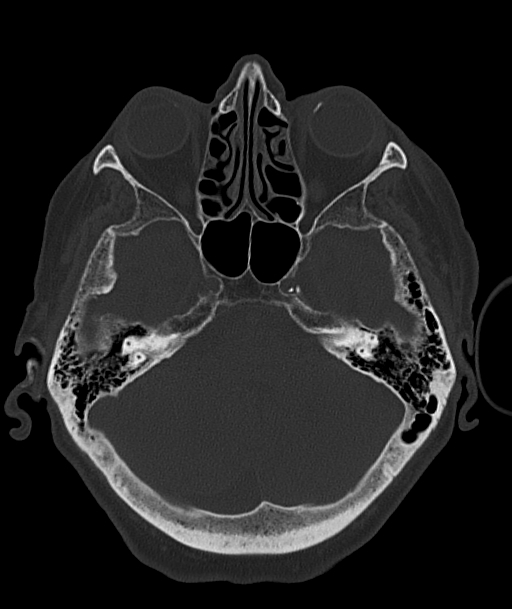 Acute traumatic subdural hematoma (Radiopaedia 82921-97257 Axial bone window 78).jpg
