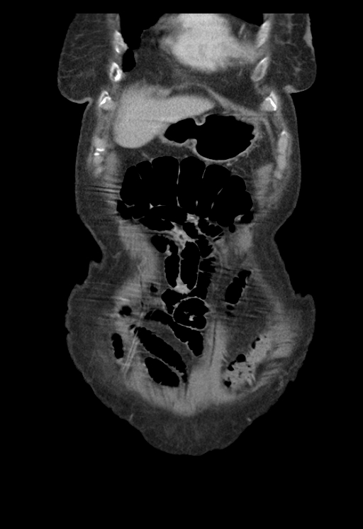 Adenocarcinoma of cecum (Radiopaedia 59222-66549 Coronal C+ portal venous phase 6).jpg