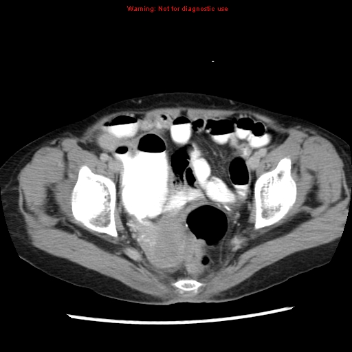 Adenocarcinoma of the colon (Radiopaedia 8191-9039 Axial renal excretory phase 53).jpg