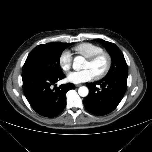 File:Adenocarcinoma of the lung (Radiopaedia 59871-67325 Axial C+ arterial phase 57).jpg