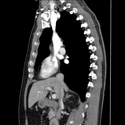 File:Adenocarcinoma of the lung (Radiopaedia 59871-67325 Sagittal C+ arterial phase 41).jpg