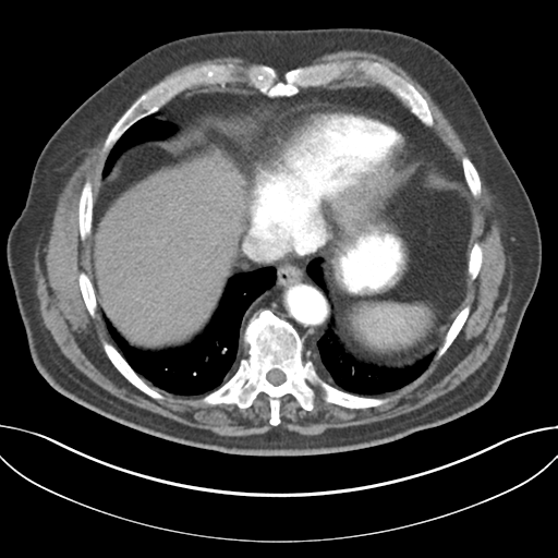 Adenocarcioma of rectum- T1 lesion (Radiopaedia 36921-38547 Axial C+ arterial phase 43).png