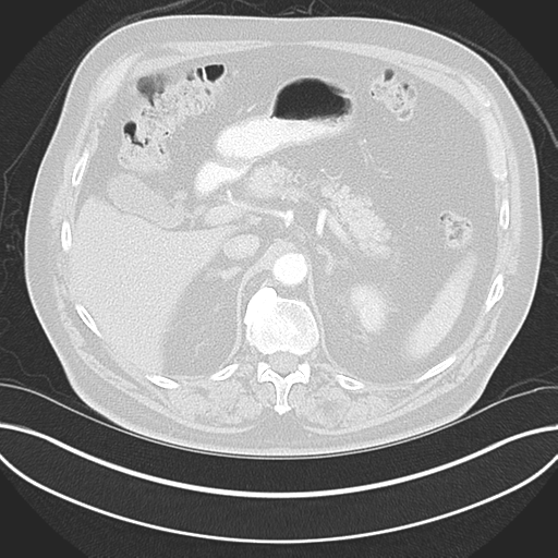Adenocarcioma of rectum- T1 lesion (Radiopaedia 36921-38547 Axial lung window 58).png