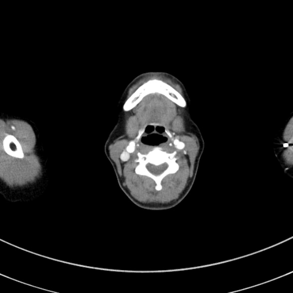 Adenocystic carcinoma of the trachea (Radiopaedia 47677-52525 Axial C+ arterial phase 16).jpg