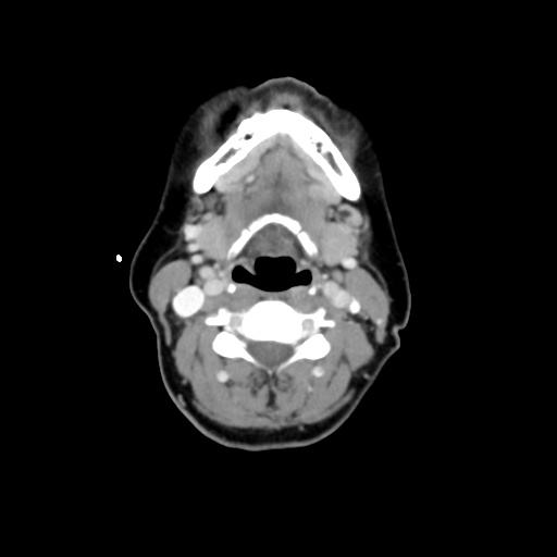 File:Adenoid cystic tumor of palate (Radiopaedia 46980-51518 Axial C+ delayed 43).png