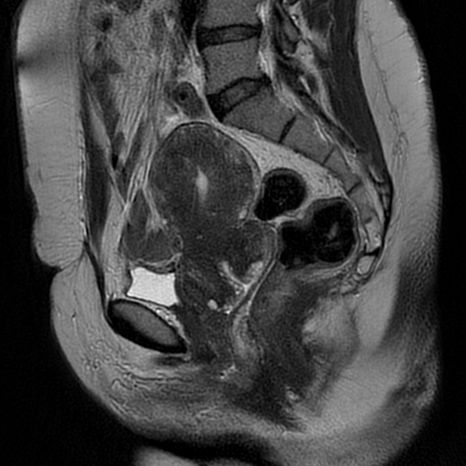 File:Adenomyosis-scar endometriosis (Radiopaedia 65863-75022 Sagittal T2 12).jpg