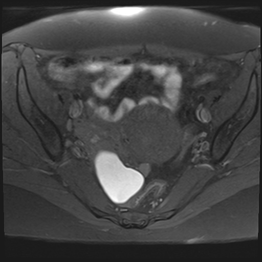 File:Adenomyosis and endometriotic cysts (Radiopaedia 82300-96367 Axial T1 fat sat 18).jpg