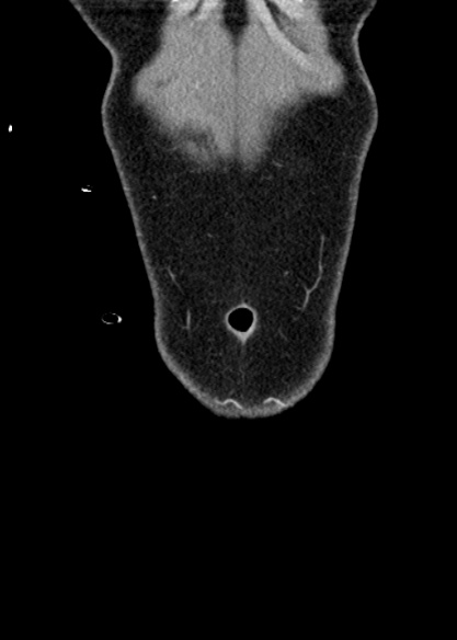 File:Adhesional small bowel obstruction (Radiopaedia 48397-53305 Coronal C+ portal venous phase 22).jpg