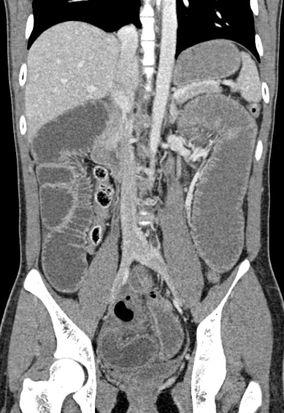 Adhesional small bowel obstruction (Radiopaedia 52107-57980 Coronal C+ portal venous phase 46).jpg