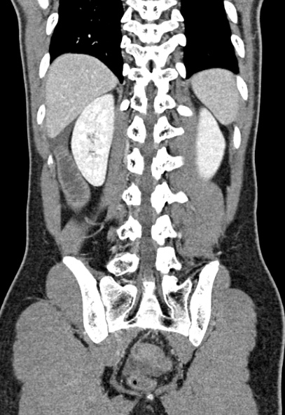 Adhesional small bowel obstruction (Radiopaedia 52107-57980 Coronal C+ portal venous phase 64).jpg