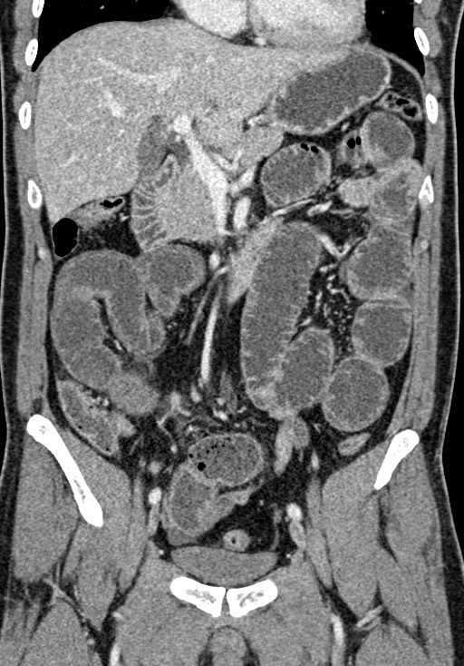 Adhesional small bowel obstruction (Radiopaedia 58900-66131 Coronal C+ portal venous phase 126).jpg