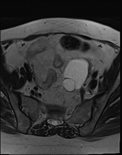 File:Adnexal multilocular cyst (O-RADS US 3- O-RADS MRI 3) (Radiopaedia 87426-103754 Axial T2 7).jpg