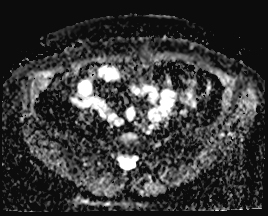File:Adnexal multilocular cyst (O-RADS US 3. O-RADS MRI 3) (Radiopaedia 87426-103754 Axial 177).jpeg