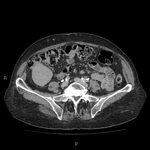 File:Adrenal collision tumor (ACT) (Radiopaedia 48462-53379 Axial C+ delayed 44).jpg