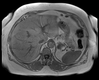 File:Adrenal cortical carcinoma (Radiopaedia 64017-72770 Axial T1 in-phase 15).jpg