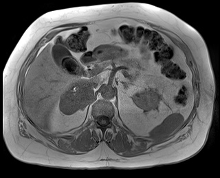 File:Adrenal cortical carcinoma (Radiopaedia 64017-72770 Axial T1 in-phase 27).jpg