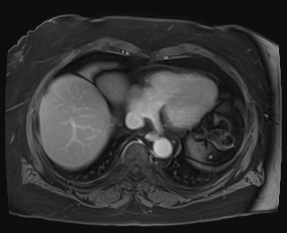 Adrenal cortical carcinoma (Radiopaedia 64017-72770 J 2).jpg