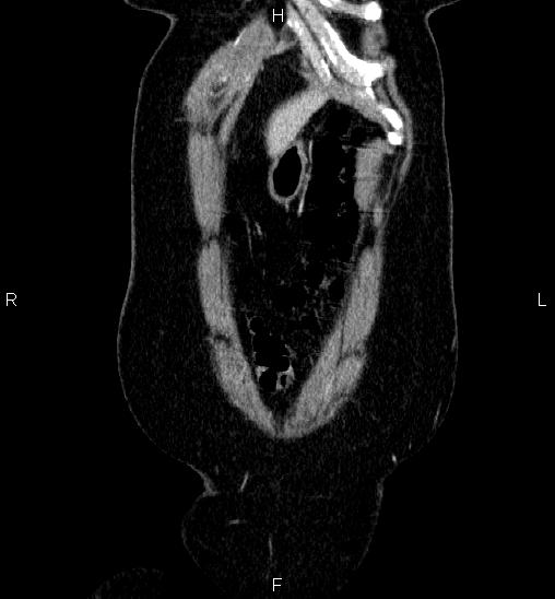 Adrenal cortical carcinoma (Radiopaedia 84882-100379 Coronal C+ portal venous phase 4).jpg