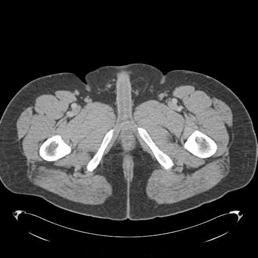 Adrenal cyst (Radiopaedia 45625-49776 Axial C+ portal venous phase 107).png