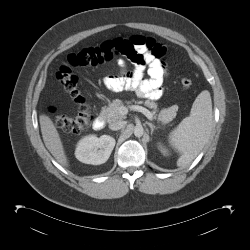 File:Adrenal cyst (Radiopaedia 45625-49776 Axial C+ portal venous phase 34).png