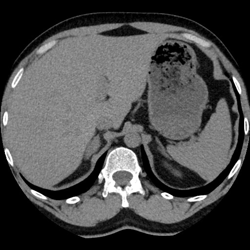File:Adrenal gland trauma (Radiopaedia 81351-95079 Axial non-contrast 25).jpg