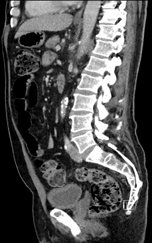 Adrenal lymphoma (Radiopaedia 73730-84529 Sagittal C+ portal venous phase 63).jpg