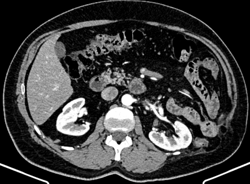 Adrenal metastases (Radiopaedia 73082-83791 Axial C+ arterial phase 73).jpg