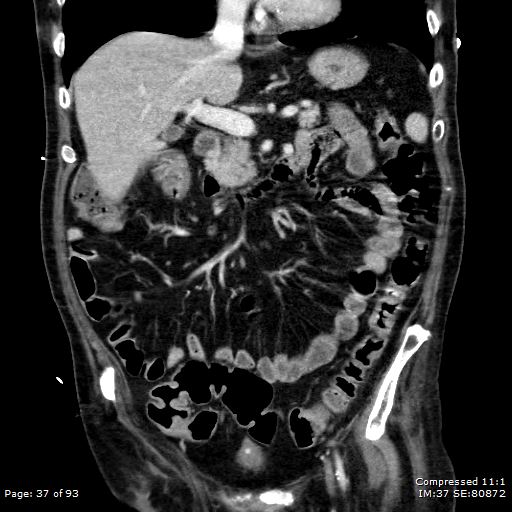 Adrenal metastasis (Radiopaedia 78425-91079 Sagittal C+ portal venous phase 24).jpg