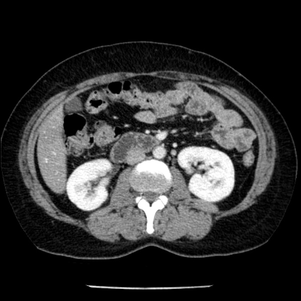 Adrenal myelolipoma (Radiopaedia 43401-46759 Axial C+ portal venous phase 40).jpg
