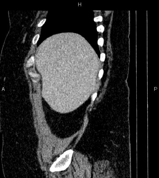 File:Adrenal myelolipoma (Radiopaedia 84319-99617 Sagittal renal cortical phase 10).jpg