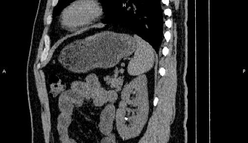Adrenal myelolipoma (Radiopaedia 84321-99619 Sagittal non-contrast 80).jpg