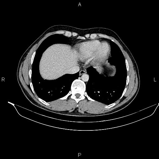 Adrenal myelolipoma (Radiopaedia 87794-104246 Axial renal cortical phase 12).jpg