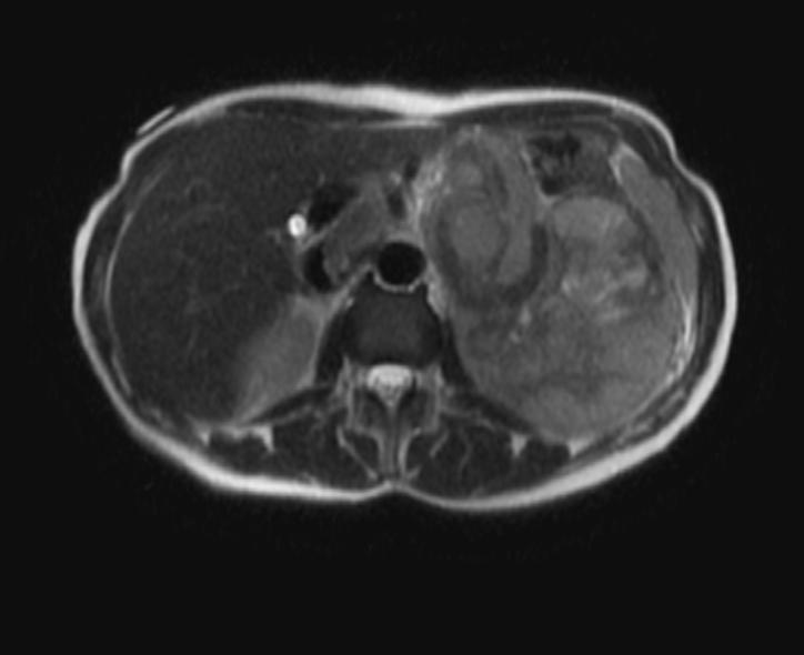 File:Adrenocortical carcinoma (Radiopaedia 11176-11541 Axial 1).jpg