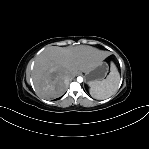 Adrenocortical carcinoma (Radiopaedia 87281-103569 Axial C+ arterial phase 17).jpg