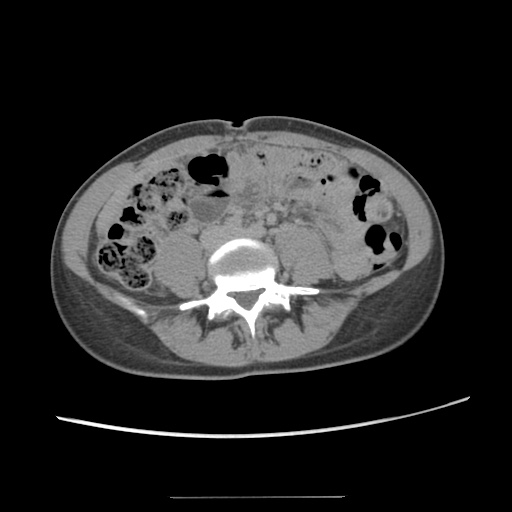 Adult polycystic kidney disease (Radiopaedia 48845-53876 Axial renal excretory phase 58).jpg