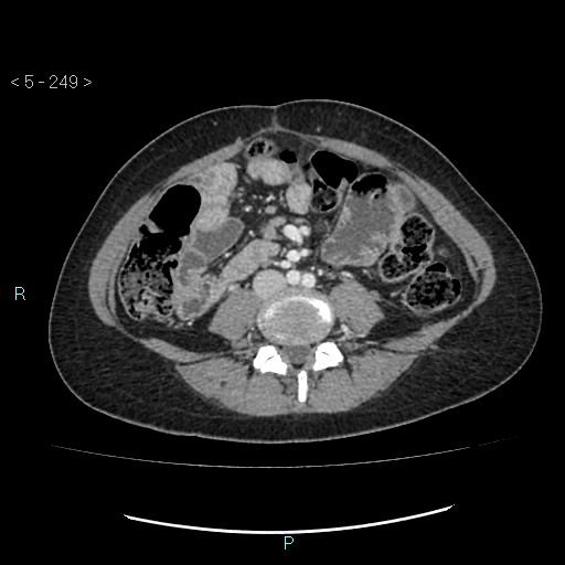 Adult transient intestinal intussusception (Radiopaedia 34853-36310 Axial C+ portal venous phase 52).jpg