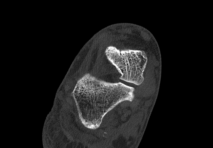 File:Advanced osteomyelitis due to open metatarsal fracture (Radiopaedia 83891-99095 Axial bone window 12).jpg