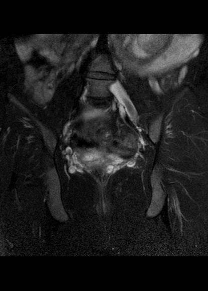 File:Aggressive angiomyxoma of the pelvis and perineum (Radiopaedia 59162-66479 Coronal T2 fat sat 18).jpg