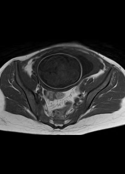 File:Aggressive angiomyxoma of the pelvis and perineum (Radiopaedia 59162-66479 T1 19).jpg