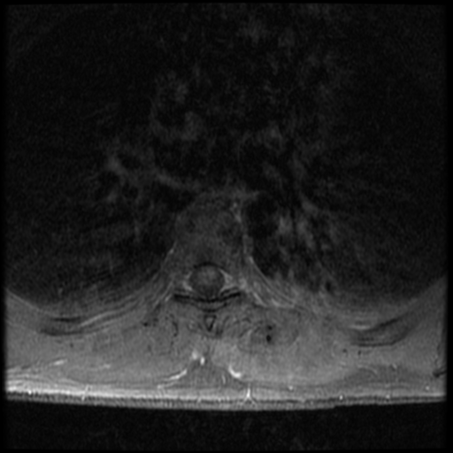 File:Aggressive vertebral hemangioma (Radiopaedia 39937-42404 Axial T1 C+ fat sat 22).png