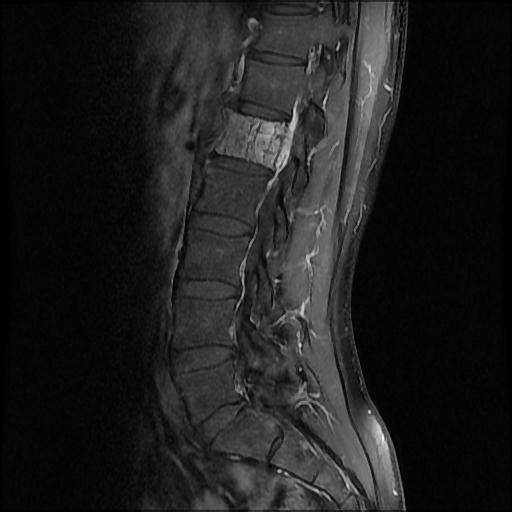 File:Aggressive vertebral hemangioma with pathological fracture (Radiopaedia 69528-79411 F 3).jpg