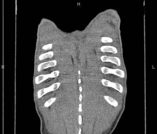 Air bronchogram in pneumonia (Radiopaedia 85719-101512 Coronal non-contrast 59).jpg