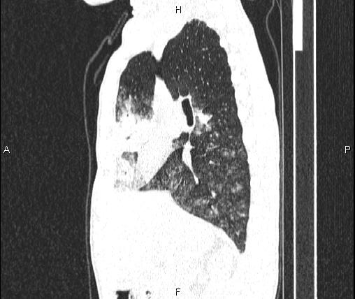 Air bronchogram in pneumonia (Radiopaedia 85719-101512 Sagittal lung window 39).jpg