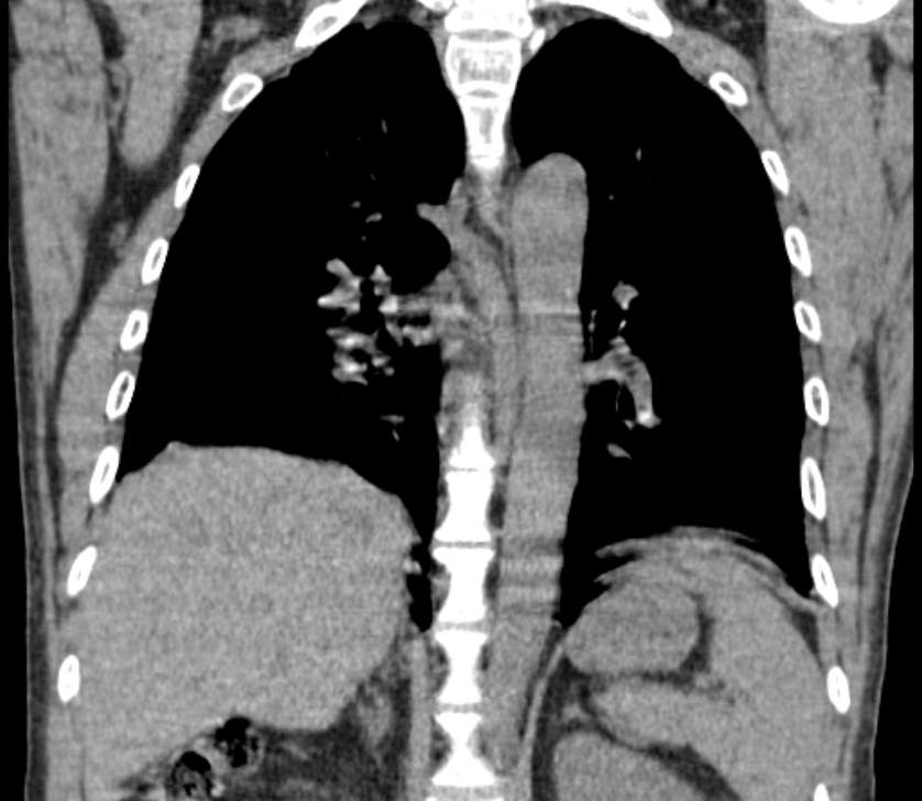 Airway foreign body in adult (Radiopaedia 85907-101779 Coronal liver window 173).jpg
